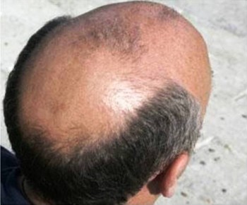 Beware, Ritual Killers Find Bald-Headed Men Lucrative, Say They’re ‘Gold’