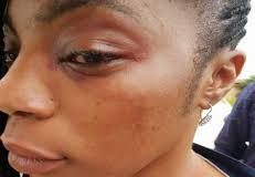 How I Was Beaten, Stripped Naked At PDP Primary – Benue Assembly Female Aspirant