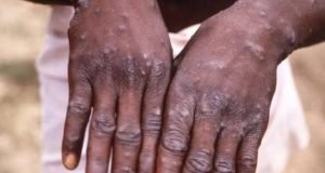 Outbreak Of Chicken Pox Hits Abuja Community, Private School Shut Down